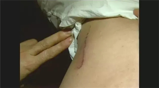 兩廚師因瑣事打架，其中一個被打破頭，然后，竟要求老板賠償10萬元……