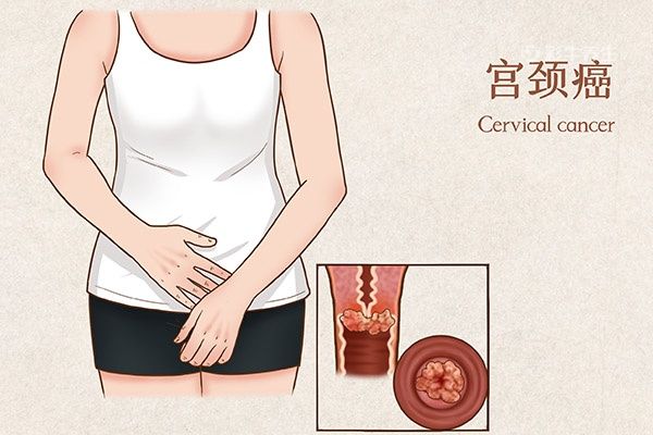 宮頸癌2.jpg
