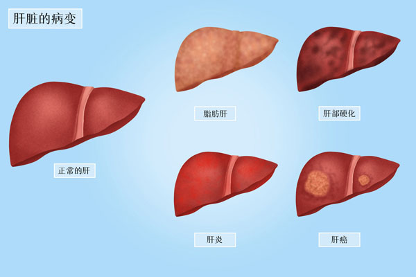 攝圖網_401948450_banner_肝臟的病變醫療插畫（企業商用）.jpg