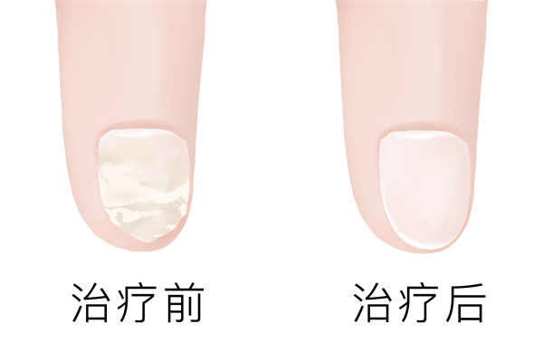 正規醫院怎么治療灰指甲 治療灰指甲哪種藥最好