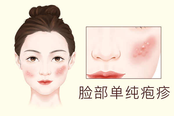 皰疹是什么原因引起的 皰疹的原因是什么