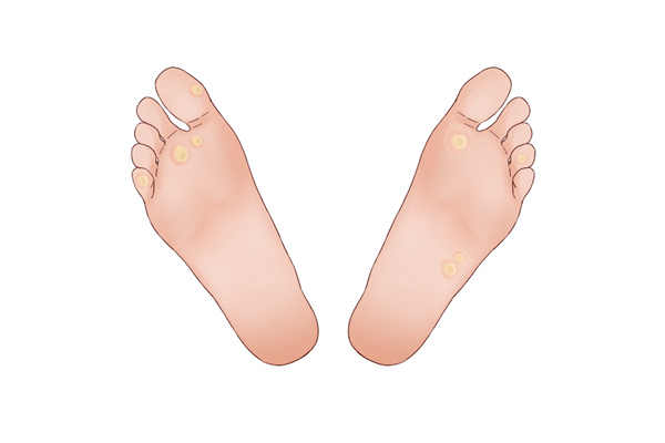 雞眼怎么根治