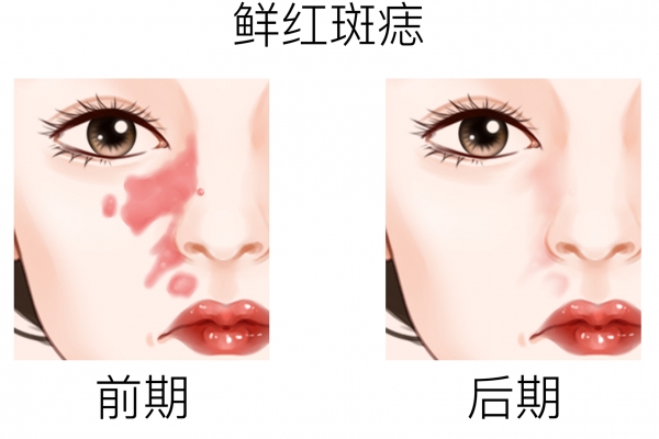 光子嫩膚能祛斑嗎