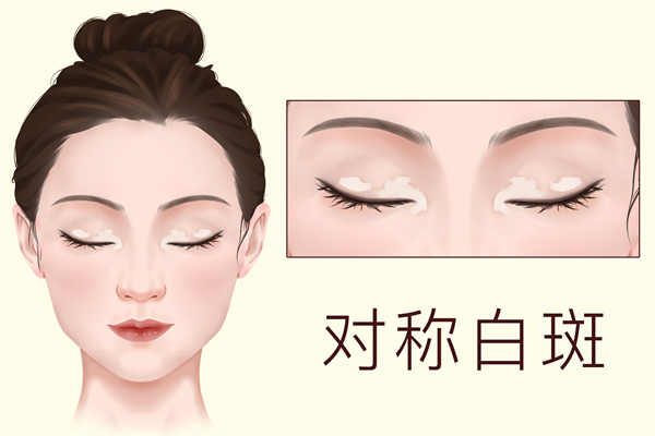 光子祛斑能維持多久？術后應注意什么？