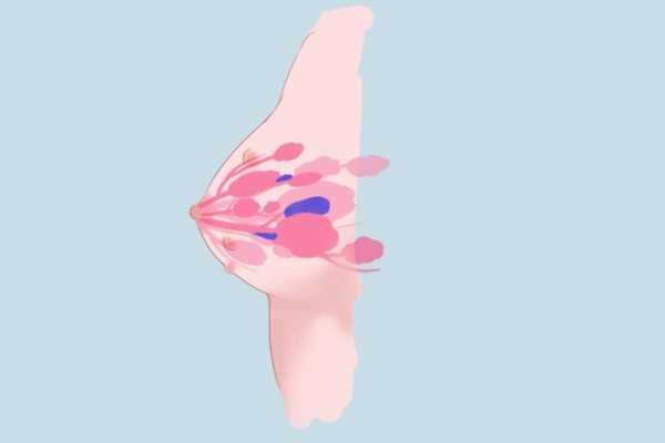 乳腺癌Ki-67陽性率30%的預后情況 乳腺癌Ki-67陽性率30%會出現什么預后情況