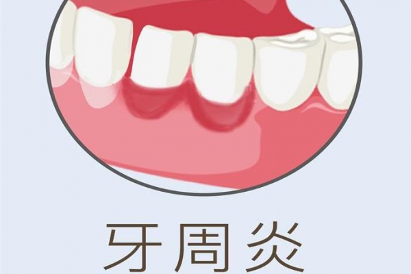 牙齦黑三角是怎么回事