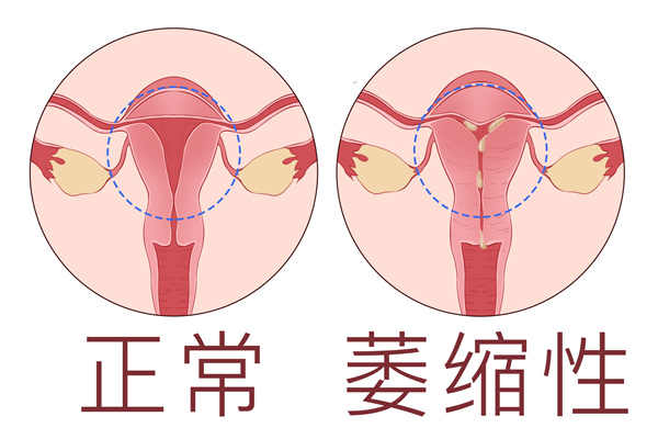 宮縮是什么感覺的