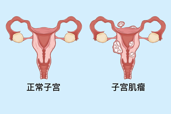 子宮肌瘤有哪些癥狀 子宮肌瘤有哪些癥狀表現