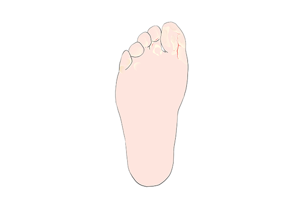 腳后跟干裂起硬皮怎么辦