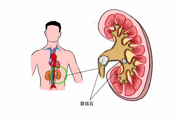 腎病能吃羊肉嗎