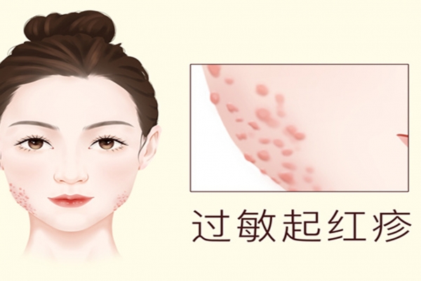 過敏可以吃羊肉嗎